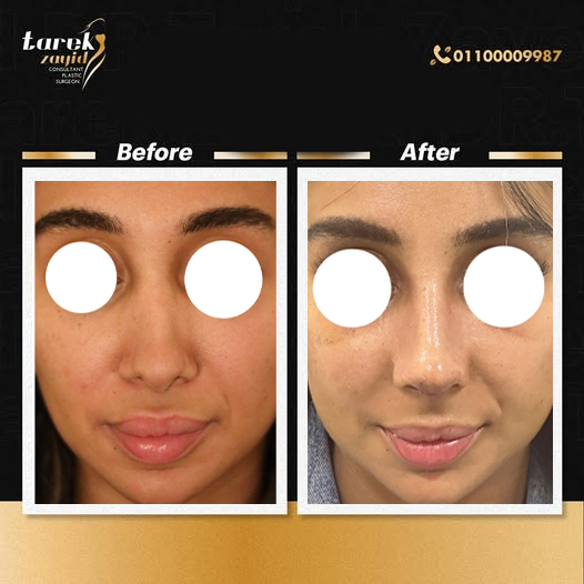 تجربتي مع عملية تجميل الأنف